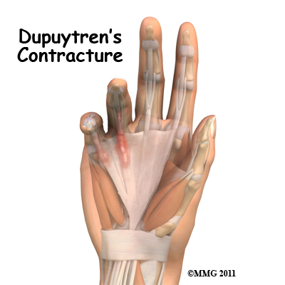 Dupuytrens Contracture Surgery Patient Guide