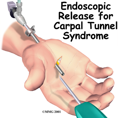 Endoscopic Carpal Tunnel Release Patient Guide
