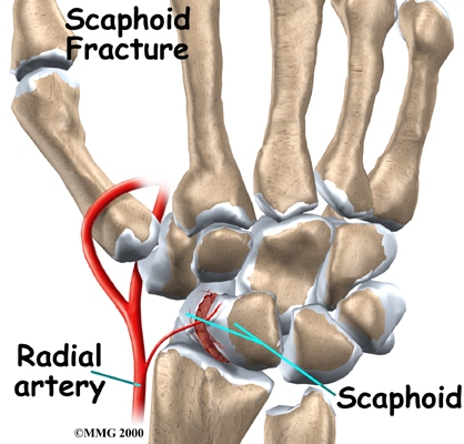 Scaphoid Fracture of the Wrist
