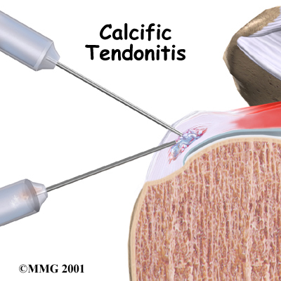 Calcific Tendonitis of the Shoulder Patient Guide