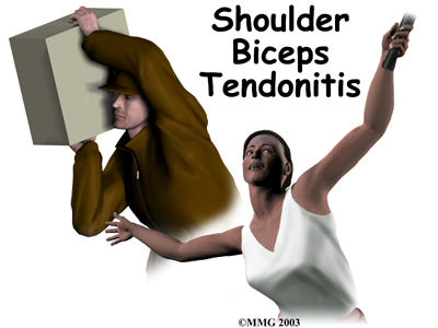 Guide to Biceps Tendonitis