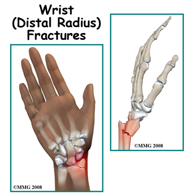Adult Wrist Fractures